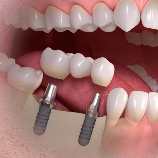 Как восстановить зубы с помощью имплантатов?